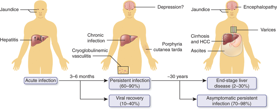 Infection of Hepatitis c