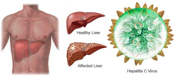 hepatitis c healthy and affected liver