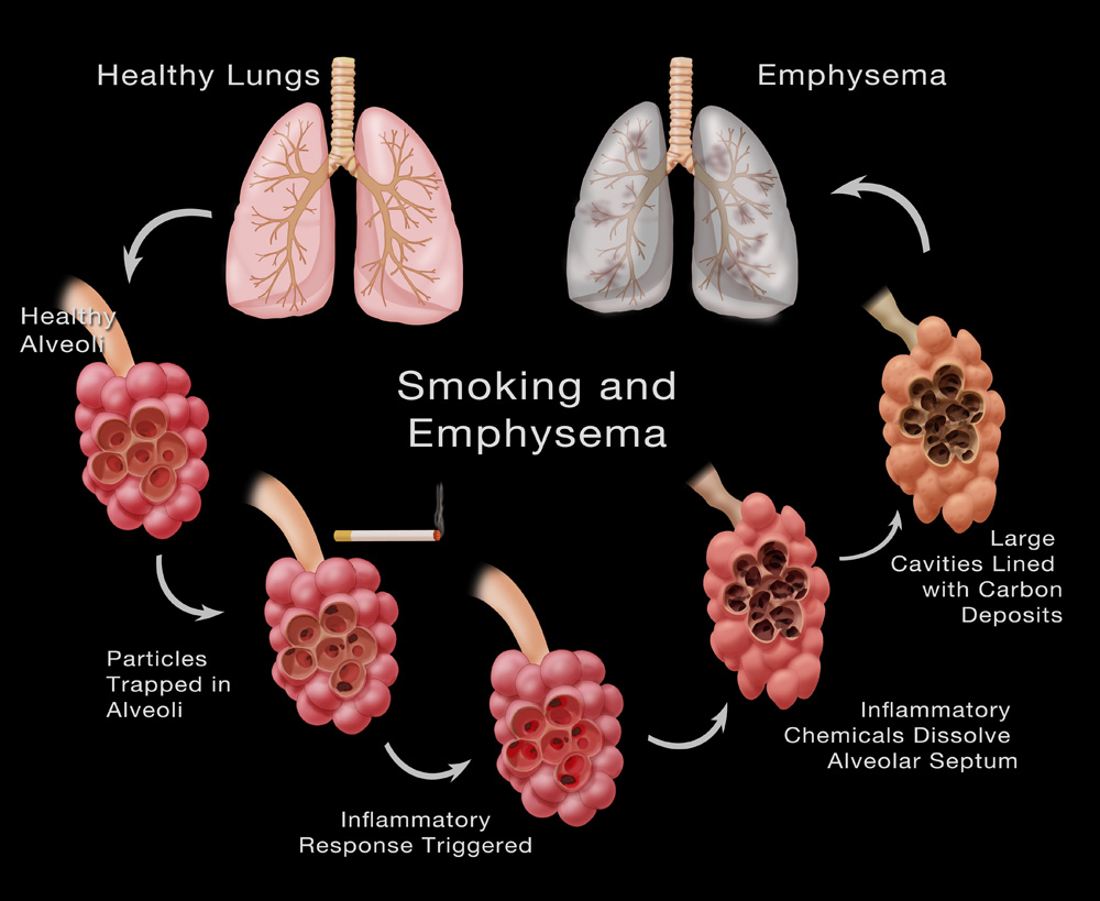 smoking and emphysema