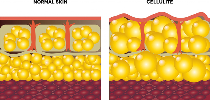 cellulite-removal-cellulite-cells