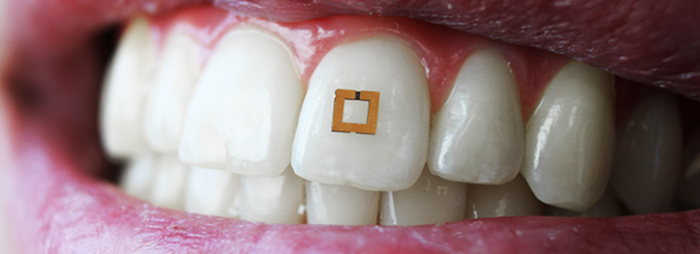 innovative-health-science-smart-tooth-sensors