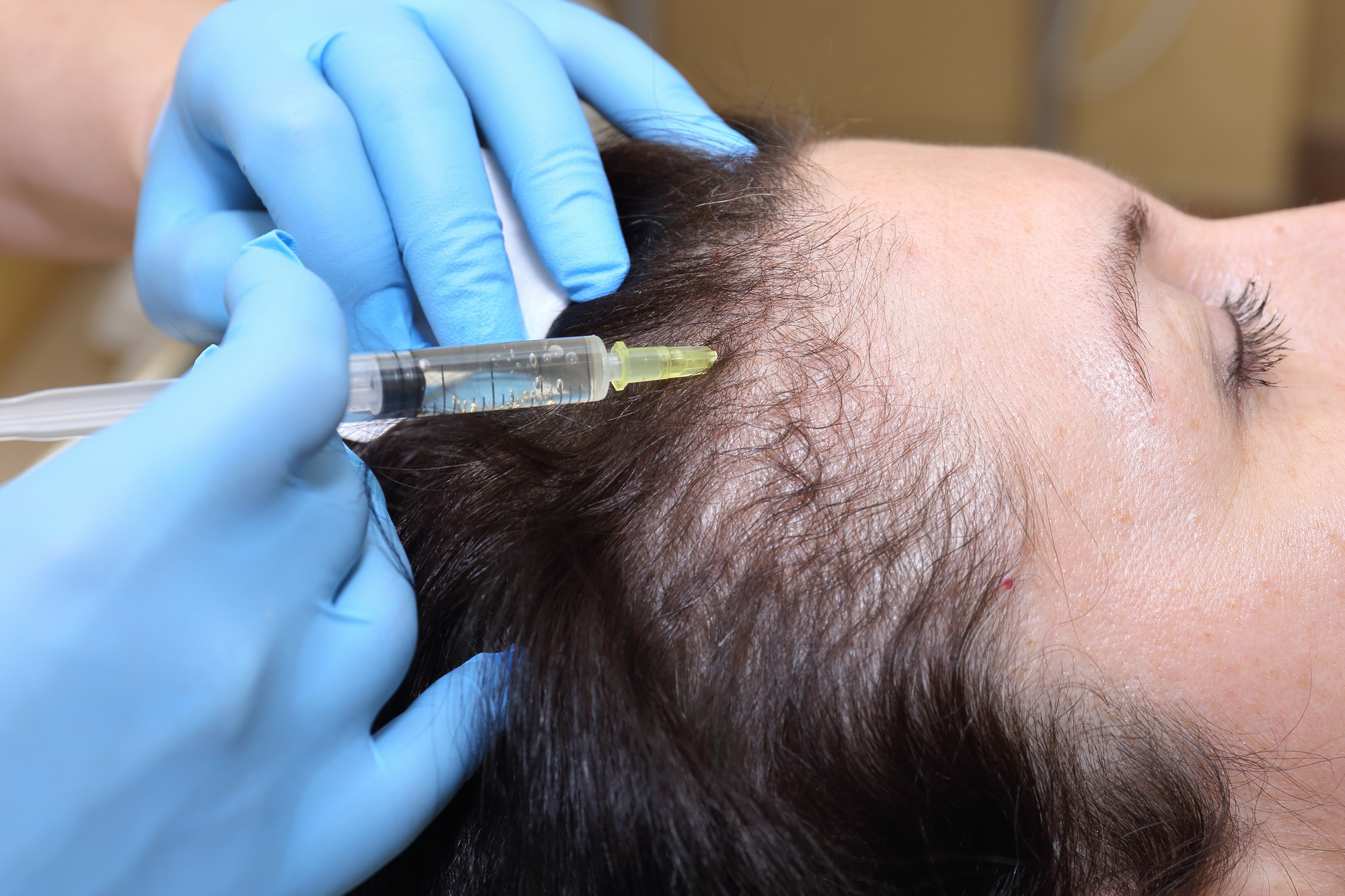 Anti hair loss injection in clinic