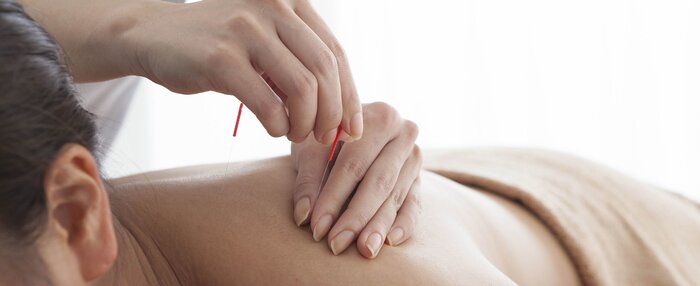 woman lying half naked and getting acupuncture with a specialist using red needles to perform acupuncture